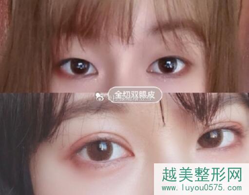 湘雅三医院整形科双眼皮案例图