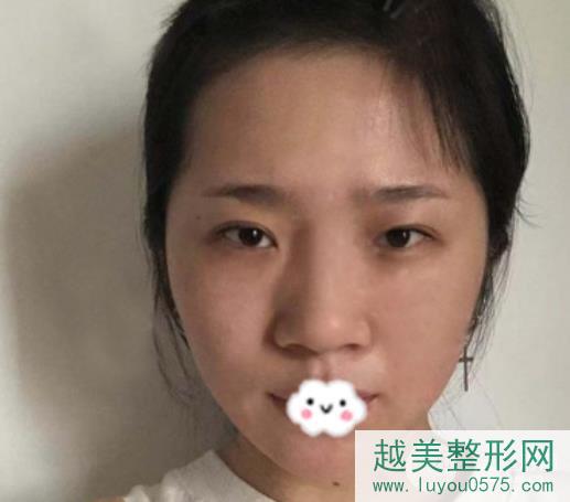 上海第九人民医院鼻翼缩小案例