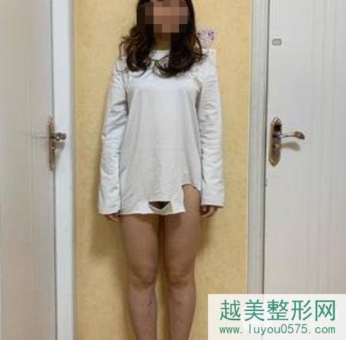 西京医院整形外科大腿吸脂案例