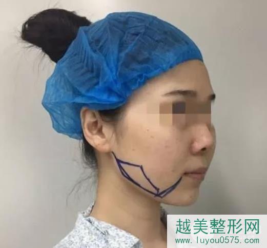 北京八大处整形医院下颌角磨骨案例