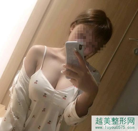 北京协和医院整形科自体脂肪隆胸案例