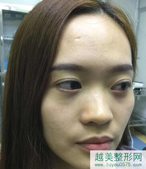 上海第六人民医院整形外科郭峰医生祛眼袋果对比！惊呆！