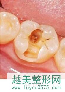 牙病治疗案例