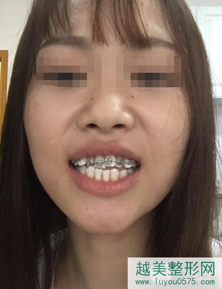 深圳阳光医院口腔科氟斑牙治疗术后3个月