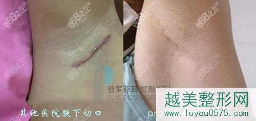 韩国普罗菲耳医院隆胸切口疤痕对比
