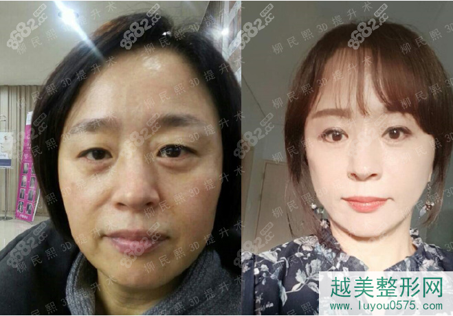 花5万多元找北京柳民熙做的面部拉皮手术真实案例对比图