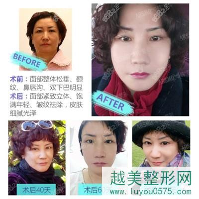 北京柳民熙拉皮手术案例图片前后对比