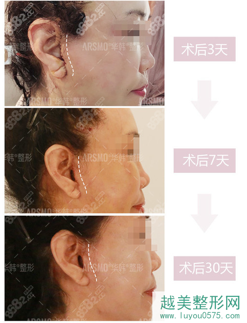 北京柳民熙面部拉皮手术术后3-30天恢复果图