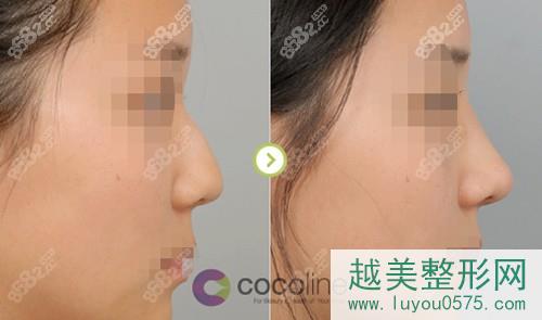 韩国Cocoline整形外科鼻整形对比照