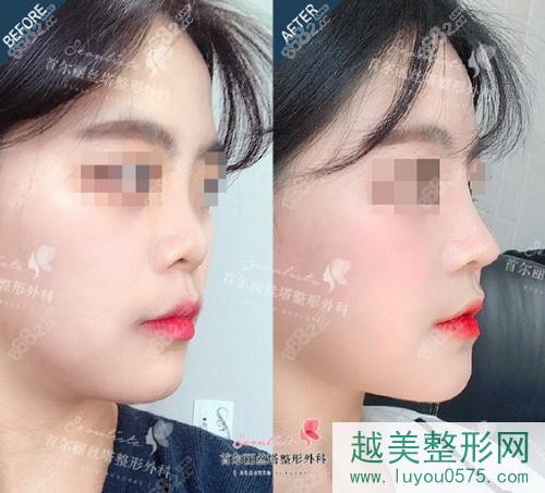 韩国丽丝塔整形外科鼻部整形案例