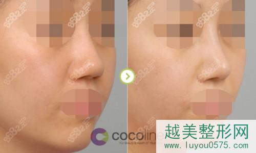 韩国Cocoline整形外科鼻整形案例