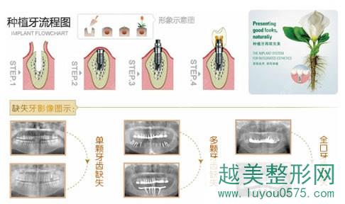 种植牙手术流程图.jpg