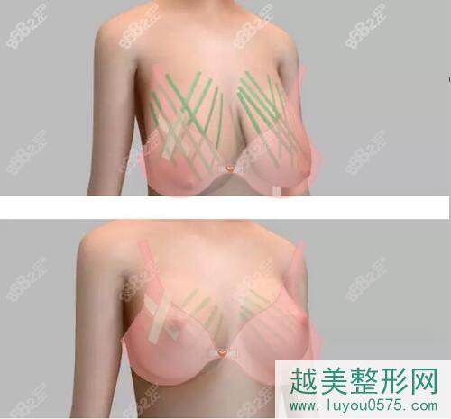 人工韧带乳房上提手术操作过程