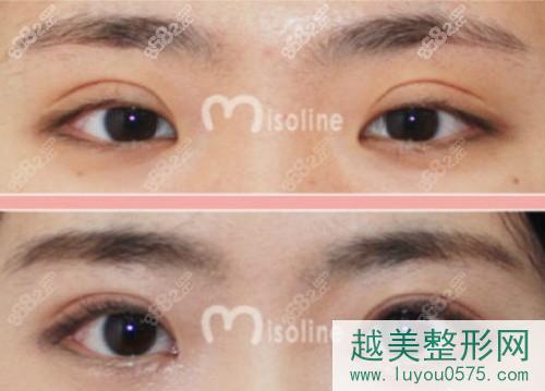  韩国Misoline整形医院双眼皮案例