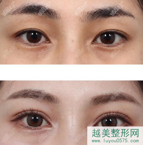 韩国1mm整形外科双眼皮前后对比