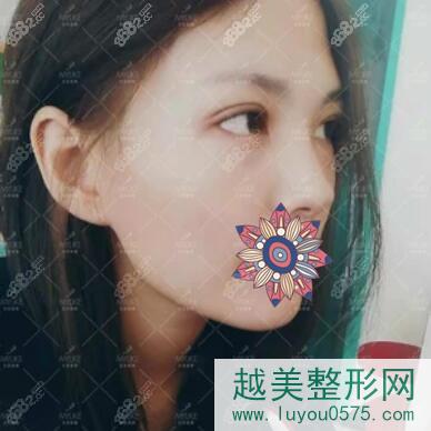在北京美莱做眼部手术术后2个月恢复果照