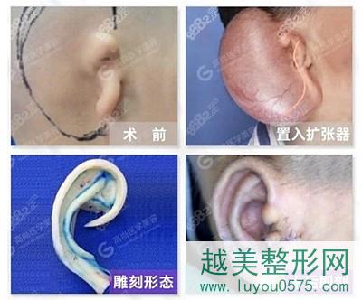 余文林医生的耳再造手术案例