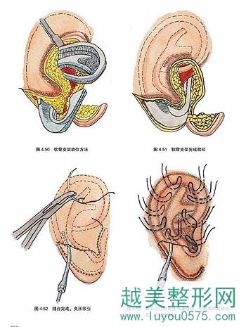 耳再造手术的过程和原理