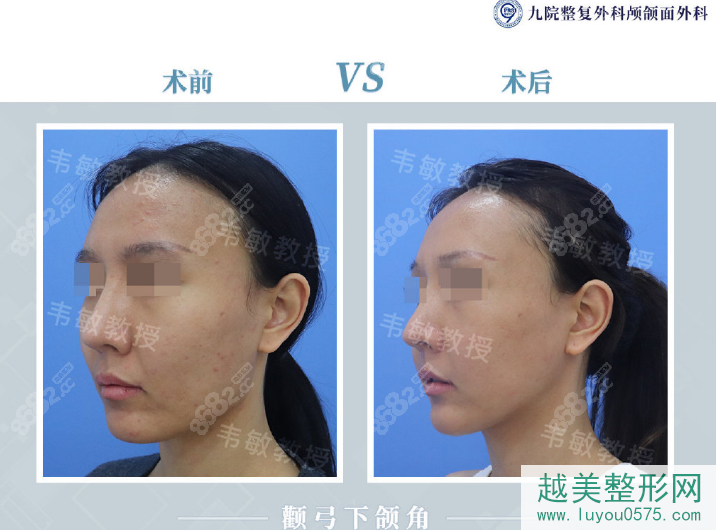 上海九院韦敏颧弓下颌角削骨案例对比图