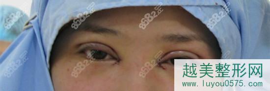 青岛德诺整形医院双眼皮手术特点展示