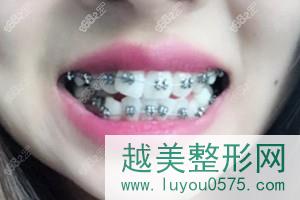 广州广大牙齿矫正案例