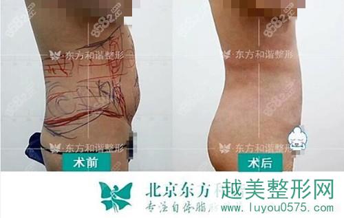 北京东方和谐腰腹部吸脂对比案例