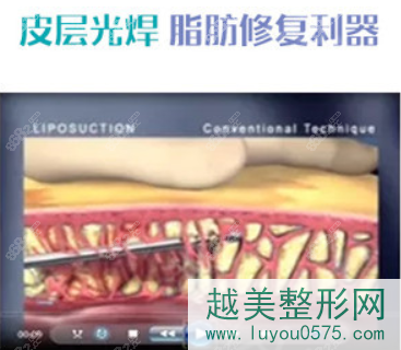 北京爱多邦王绍国皮层光焊技术