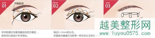 韩国必当归双眼皮手术方法