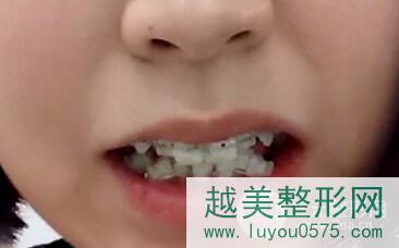 桂林口腔医院牙齿矫正案例