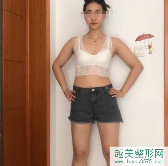 上海第九人民医院整形科吸脂案例术前