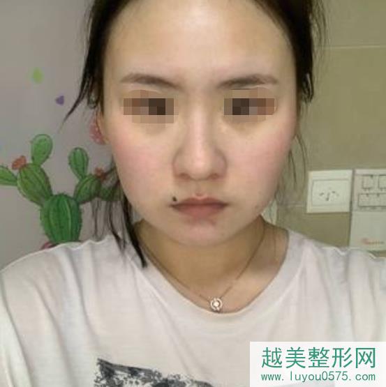 上海第九人民医院整形科下颌角案例术前