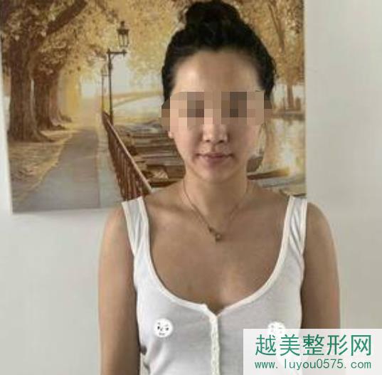 深圳北大医院整形科隆胸案例术前照