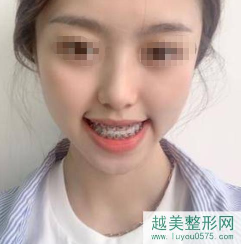 广州广大口腔医院牙齿矫正案例术后