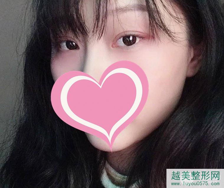 青海西宁韩美整形医院双眼皮案例术后1个月