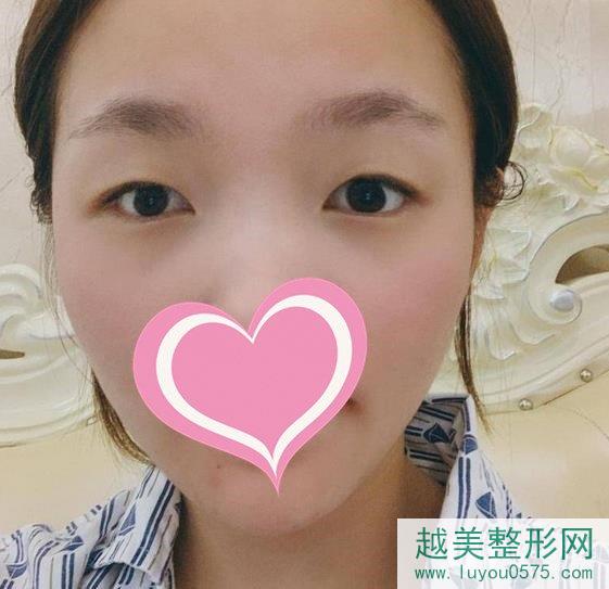 上海安缦医疗美容门诊割双眼皮案例术前