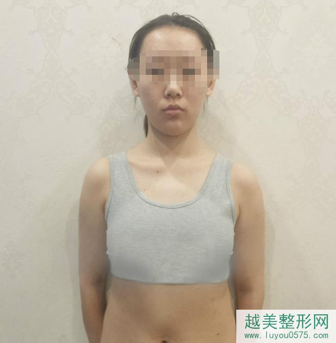 重庆五洲整形医院假体隆胸案例术前