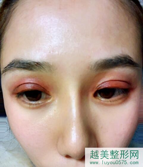 李芳整形医生割双眼皮案例术后一周