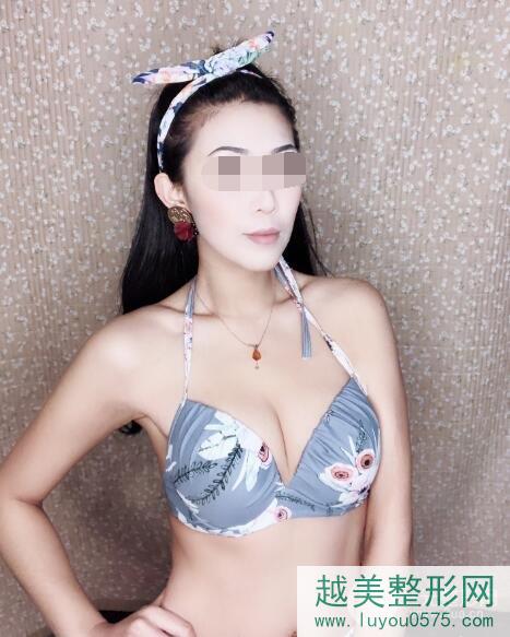 广州联合丽格医疗美容隆胸案例术后12周