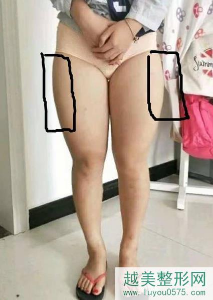 北京大学人民医院美容整形科大腿吸脂案例