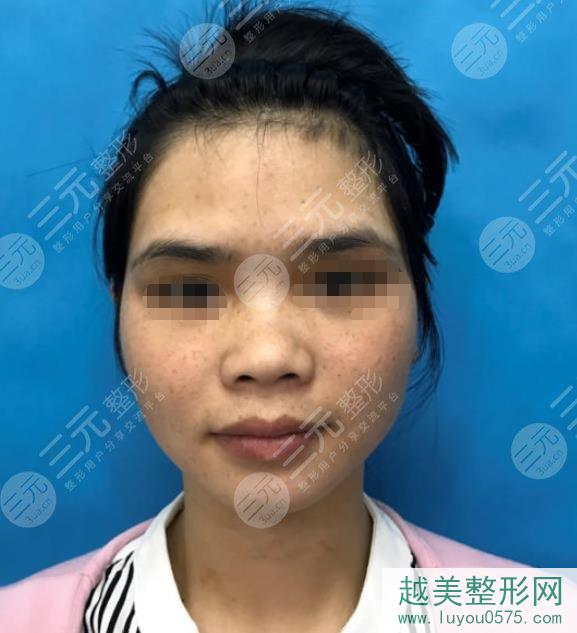 惠州第六人民医院皮肤科激光祛斑案例