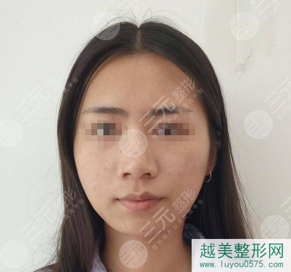 上海九医院美容科激光祛斑案例