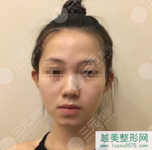 武汉中南医院整形科鼻部手术案例