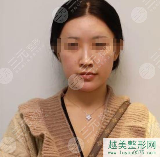广州南方医院张立宪鼻部手术案例