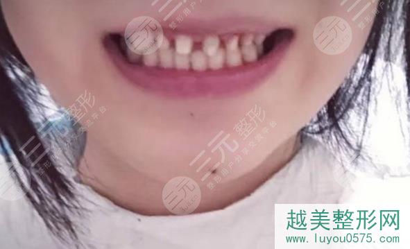 郴州第一人民医院口腔科李芬芳种植牙图片