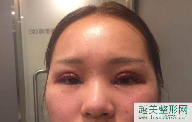 汉中中心医院双眼皮案例术后4天