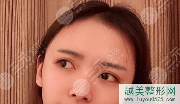 南京鼓楼医院整形外科双眼皮案例后1个月