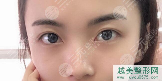 南京鼓楼医院整形外科双眼皮案例后3个月