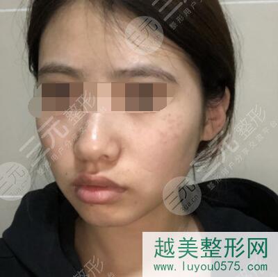 徐州医科大学附属医院整形美容中心激光祛斑案例前