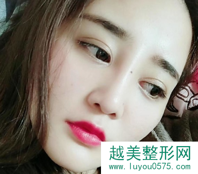 杭州格莱美张霞飞医师双眼皮+隆鼻+面部吸脂 真人案例分享