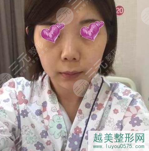 上海第九整形美容医院隆鼻案例